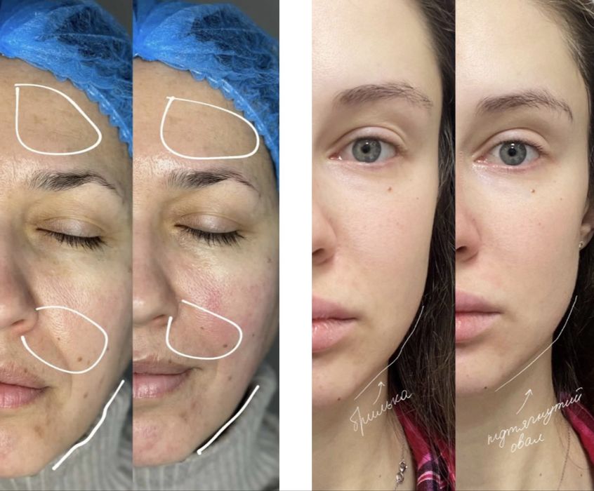 Plamine Clione Fit портативний косметологічний апарат