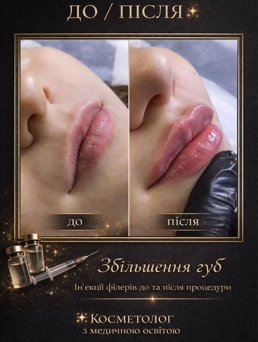 Нужны модельки на губки ,Ботокс ,Мезо .