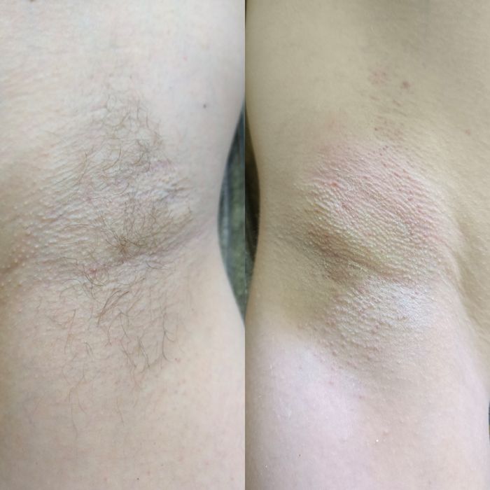 Чоловіча депіляція, видалення волосся для чоловіків на тілі та обличчі