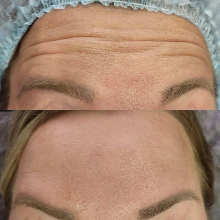 Лікар косметолог львів ботокс чистка обличя пілінг для обличя