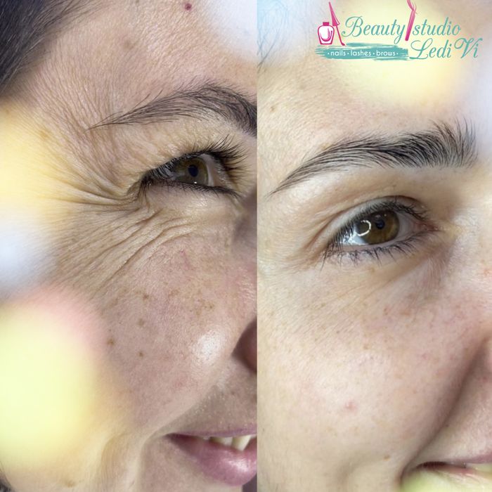 PROMOCJA! Botoks  320 Za 1 strefa