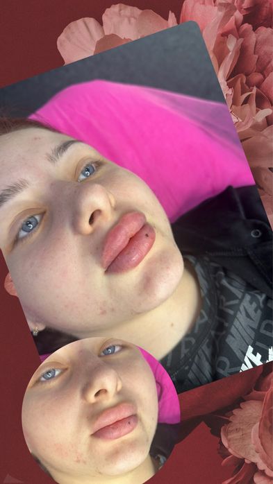 Увелечения Губ Контурная пластика