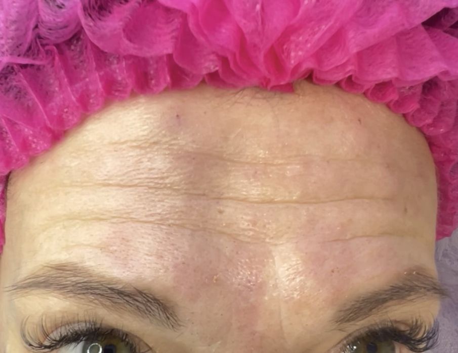 Збільшення губ 1500/3000 | лікар косметолог | моделі