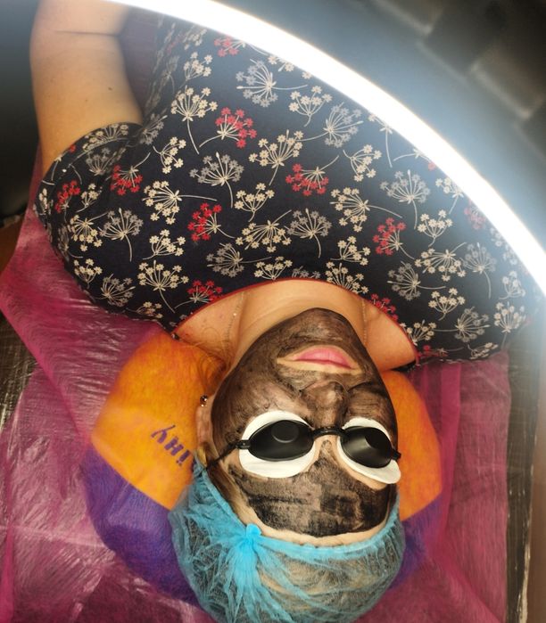 Карбоновий пілінг