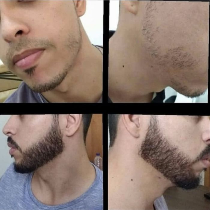 Minoxidil kirkland e Foligain extra forte