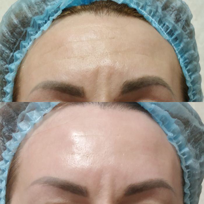 Косметолог. Ботокс, губи, векторний ліфтінг.