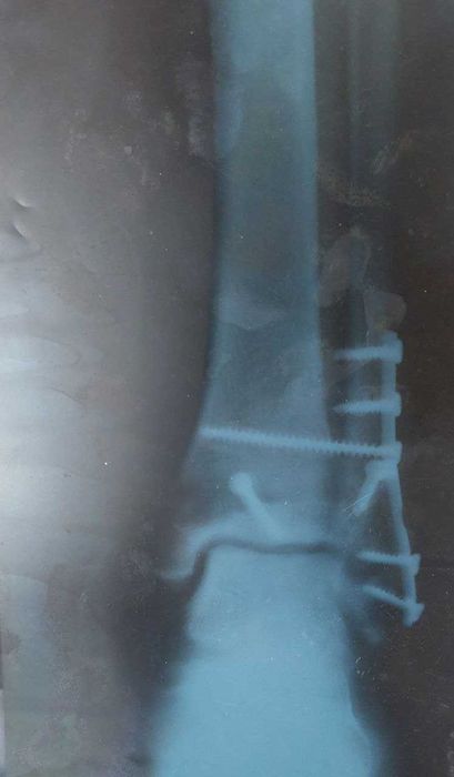 Титанова пластина