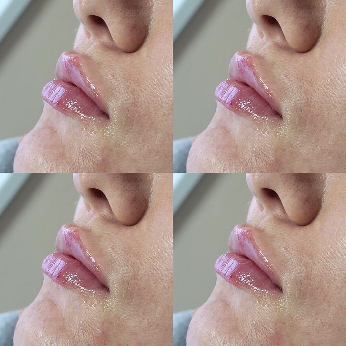 Збільшення губ КП губ Ботокс Дніпро