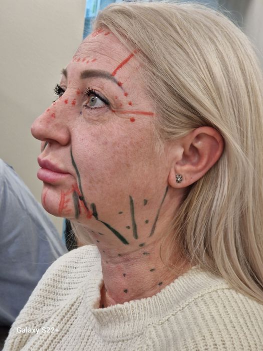 Приглашаю моделей  на косметологічні  послуги , для  съёмки  контенту.