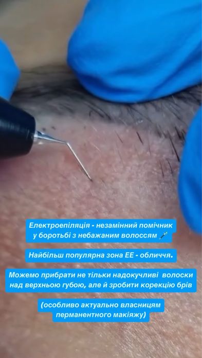 Електроепіляція / Електроепиляция
