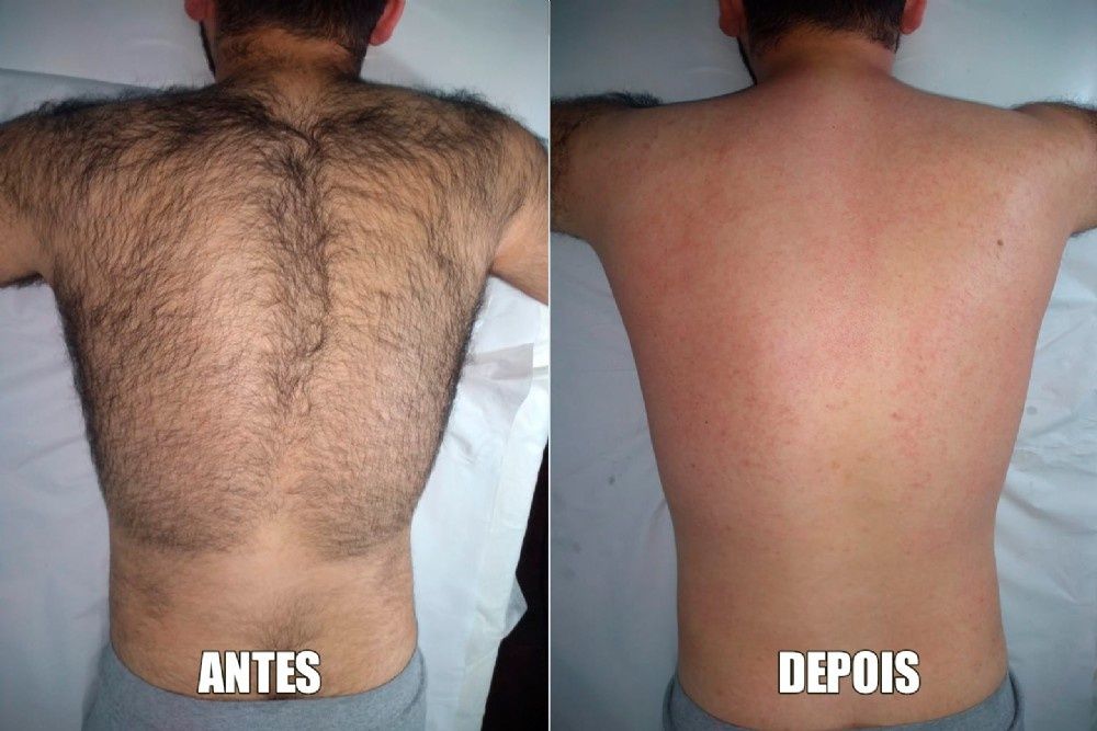 Depilação Masculina