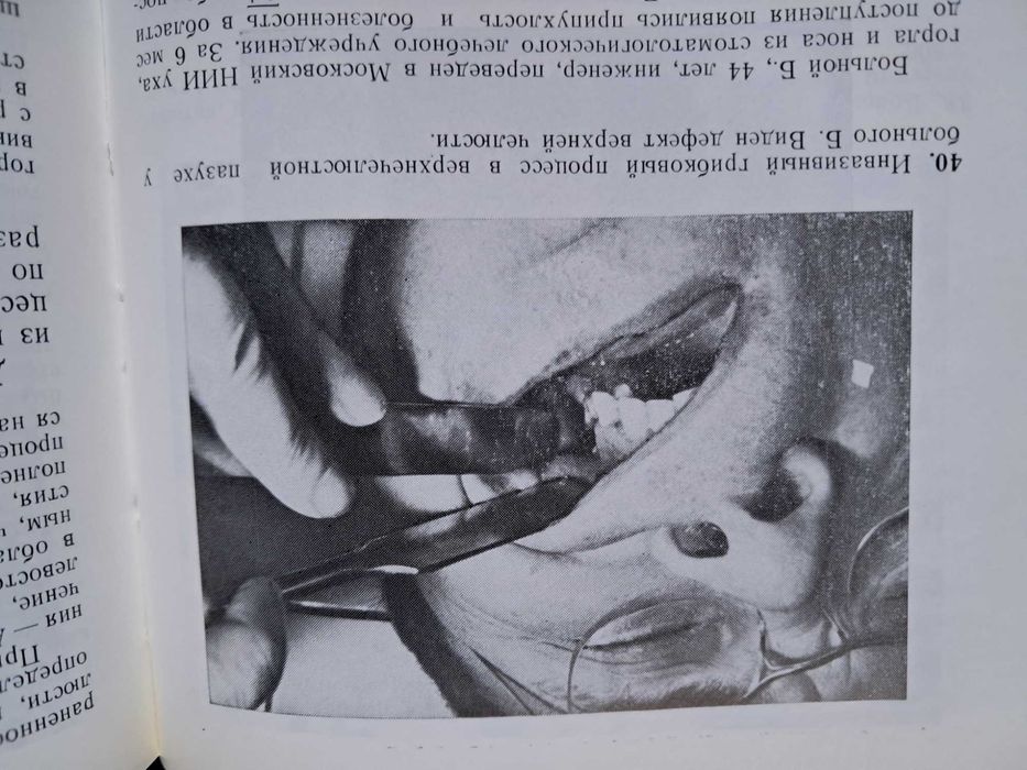 Микози в оториноларингологии