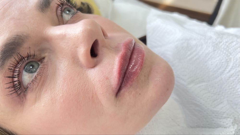 Увеличение губ , ботулинотерапия, контурная пластика