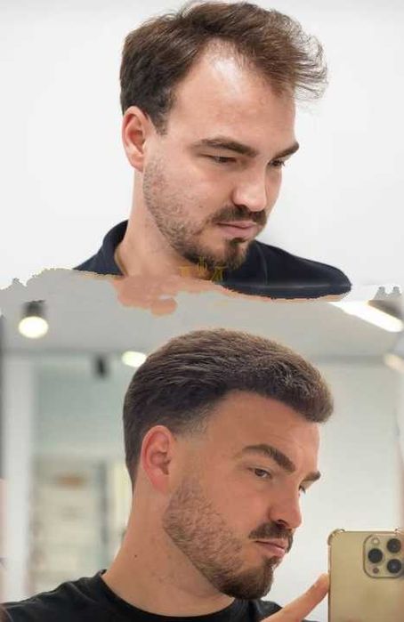 Transplante Capilar/Barba Istambul(Turquia) 2950€ TUDO INCLUIDO