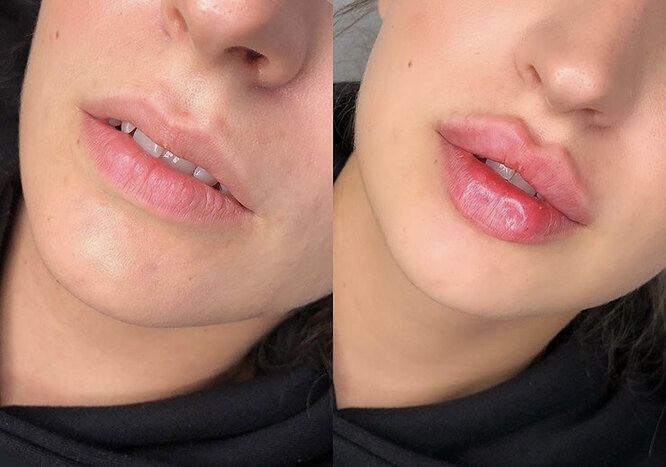 Powiekszanie ust PROMOCJA !!! Botox 200 zl