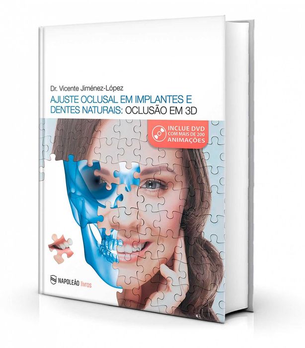 Ajuste Oclusal Em Implantes E Dentes Naturais: Oclusão em 3D
