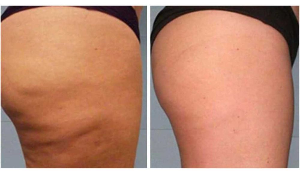 Usta/botox/mezoterapia