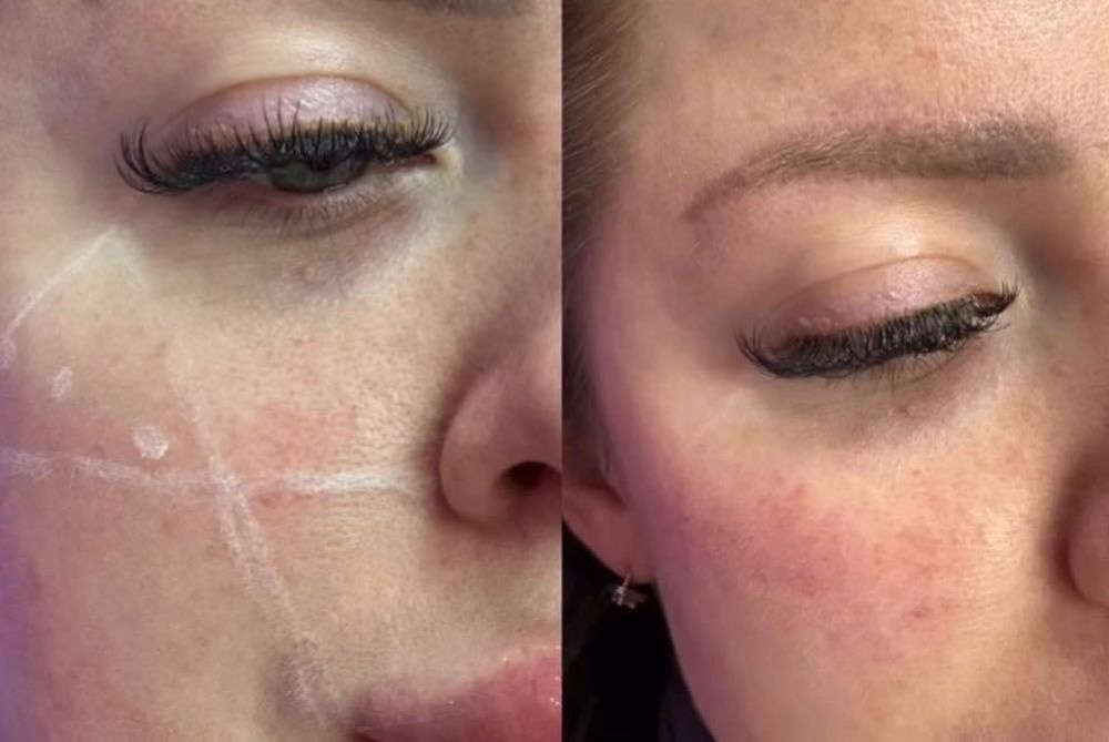 Збільшення губ ,Ботокс,Full Face,ліполітики