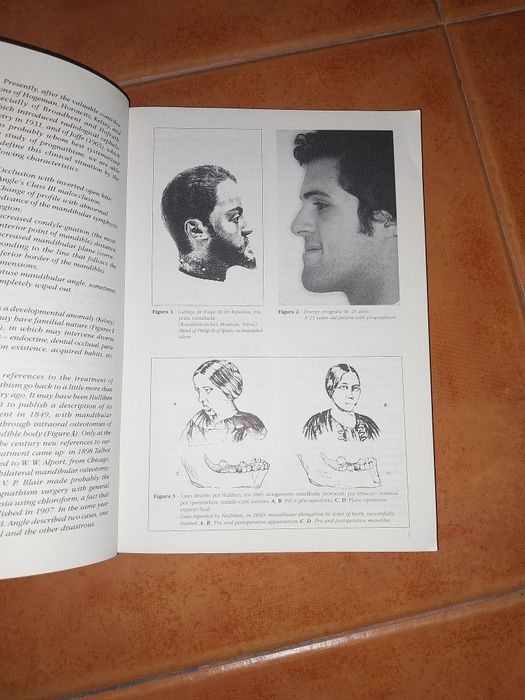 Anomalias de Classe III Prognatismo - Medicina  Dentária
