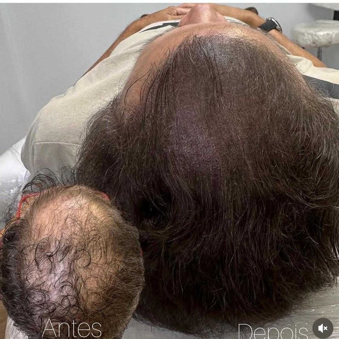 Micropigmentação capilar.