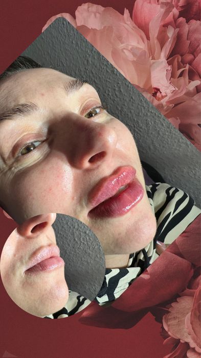 Увелечения Губ Контурная пластика