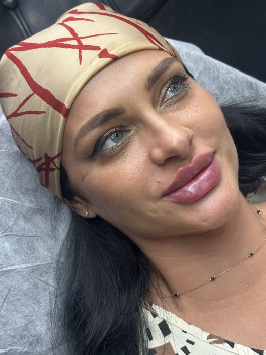 Увеличение губ и ботокс