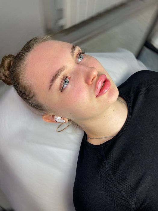 Косметолог, увеличить губы, пілінг, контурна пластика