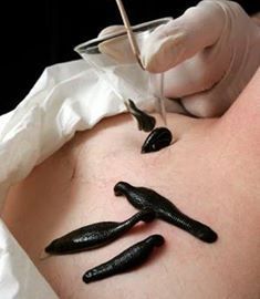 Лікування Гірудо- Рефлексотерапія Відпочинок (Лікар Дяків О.Б.)