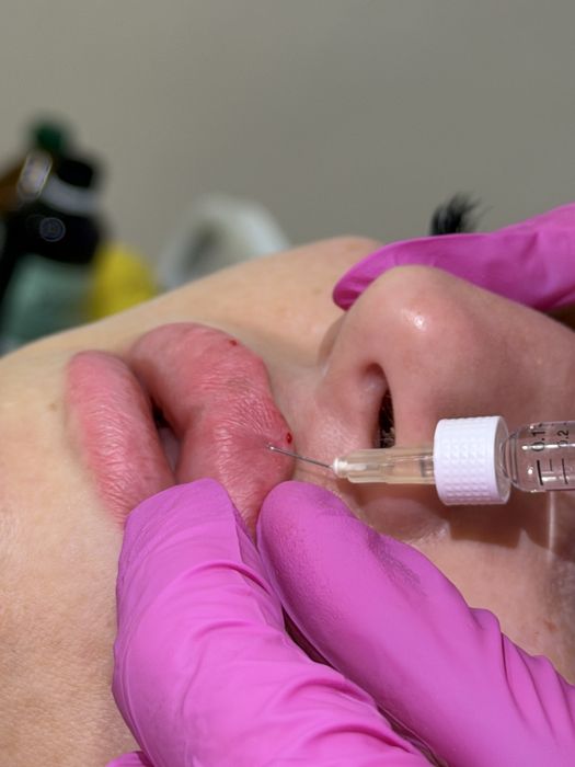 Збільшення губ 1800 грн