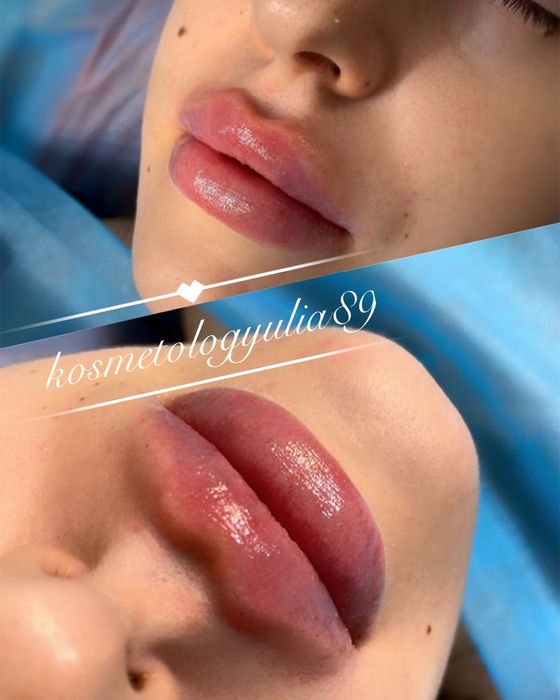 Увеличение губ от 2300 грн Sardenya Deep