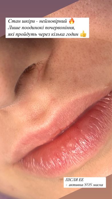 Електроепіляція / Електроепиляция