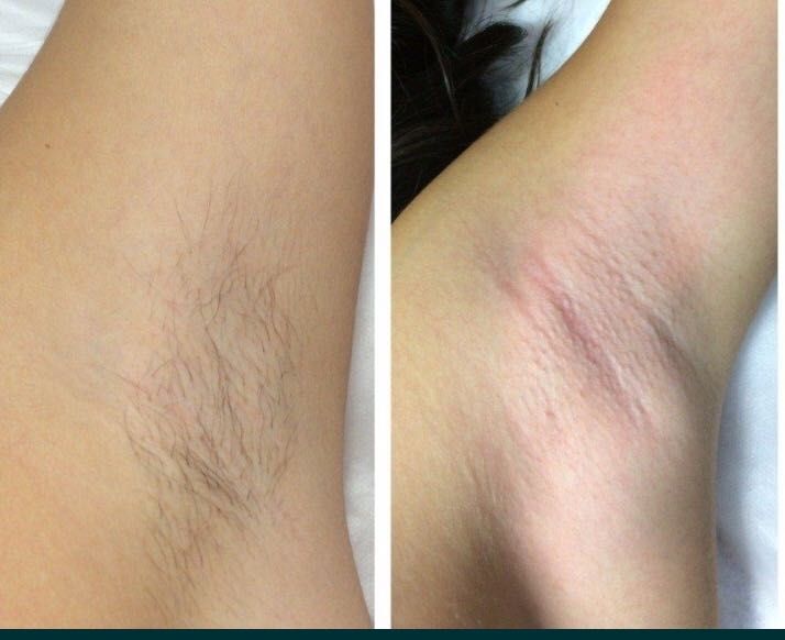 Шугаринг ,цукрова депіляція