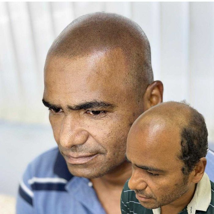 Micropigmentação capilar.