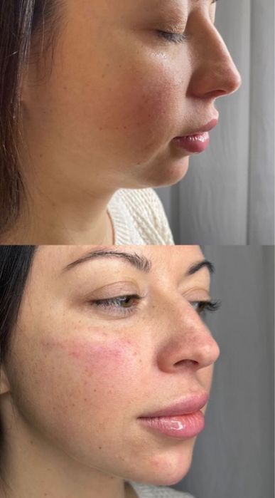 Косметолог. Губы . подбородок, углы нижней челюсти. Углы Джоли.