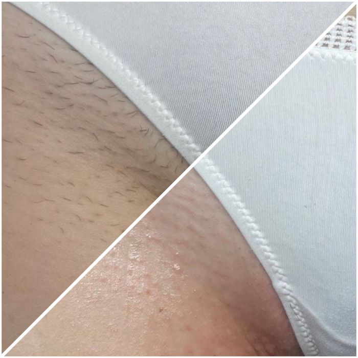 Электроэпиляция, поселок Котовского