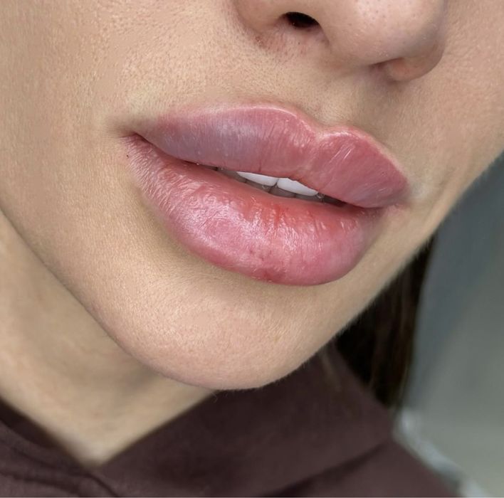 Контурна пластика, ін’єкції, ботокс