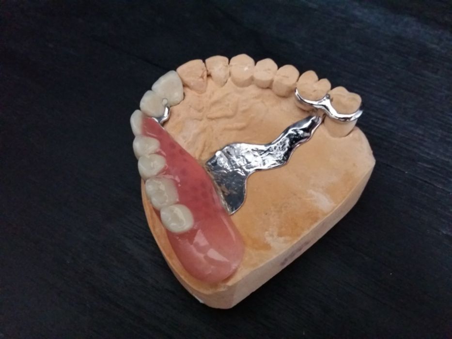 Съемное протезирование с выездом на дом