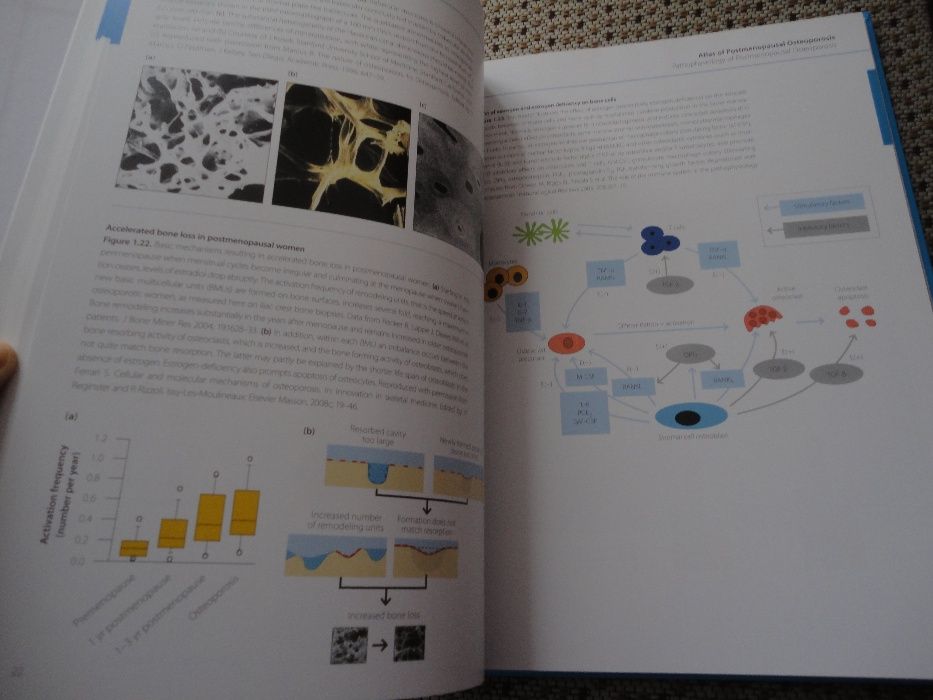 Livro Atlas of Postmenopausal Osteoporosis: Third Edition