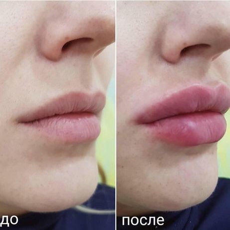 Ботокс в верхнюю губу фото отзывы Ботокс в верхнюю губу фото отзывы