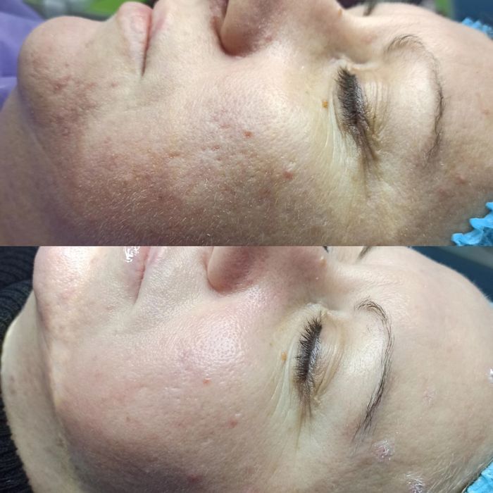 Косметолог Чистка лица Пилинг Rf лифтинг