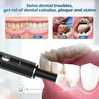 Ultradźwiękowe urządzenie do czyszczenia kamienia nazębnego