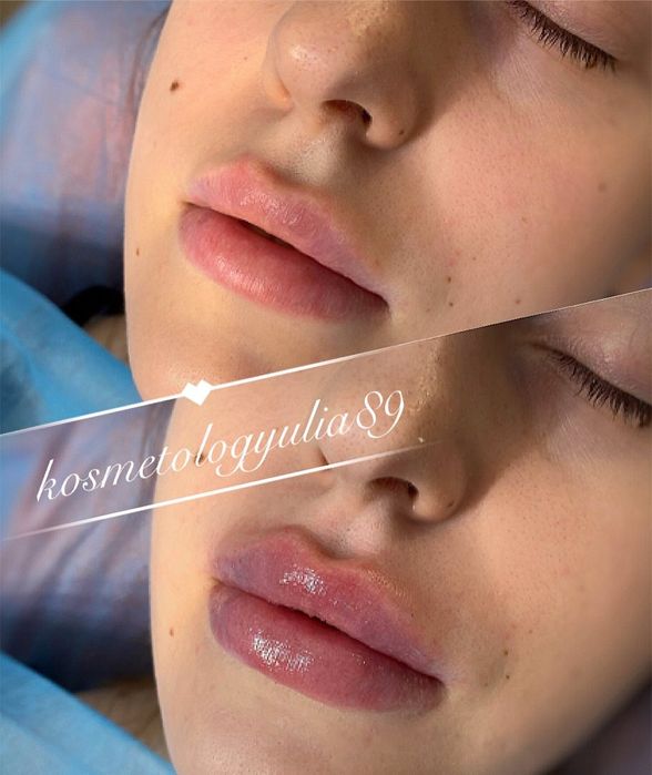 Увеличение губ от 2300 грн Sardenya Deep