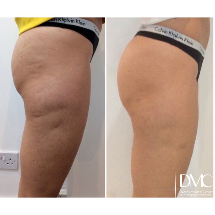 Масаж Ендосфера для жінок