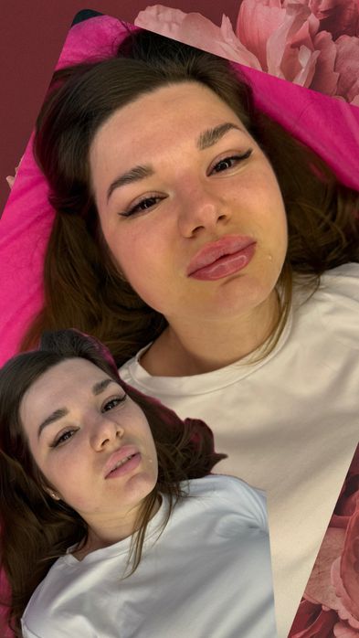 Увеличения Губ Контурная пластика,ботокс