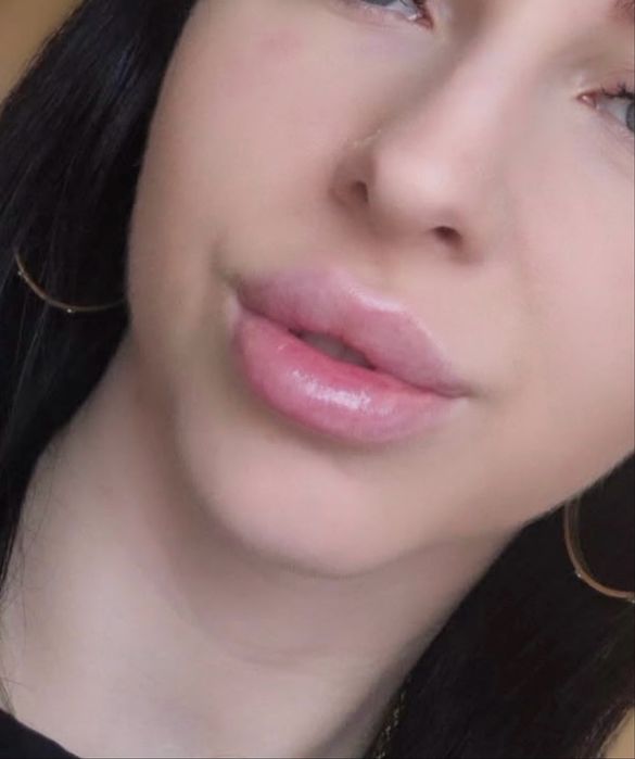 Kwas hialuronowy, botox