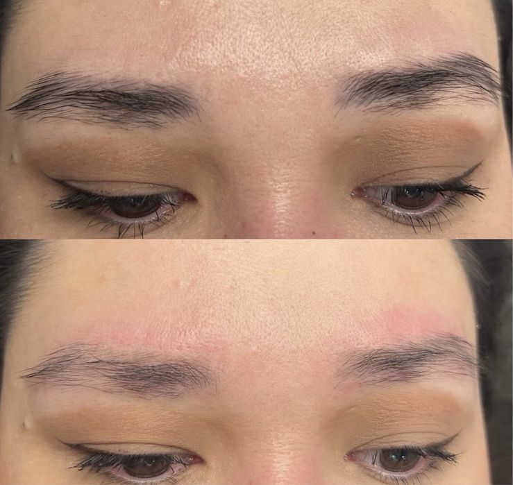 Видалення татуювання, перманенту