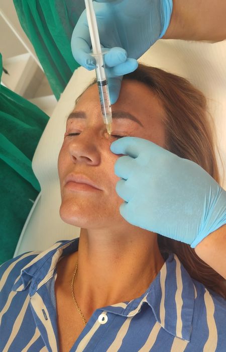 Mezoterapia  od 350 zl.  Wrocław z dojazdem