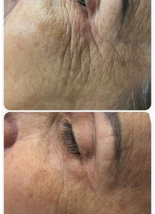 Hifu, microagulhamento, Microblading,
