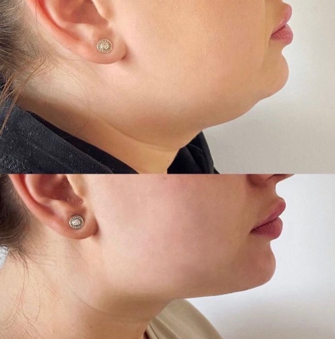 Косметолог.Увеличение губ.Мезотерапия Биоревитализация,Плазмолифтинг,