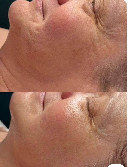 Hifu, microagulhamento, Microblading,